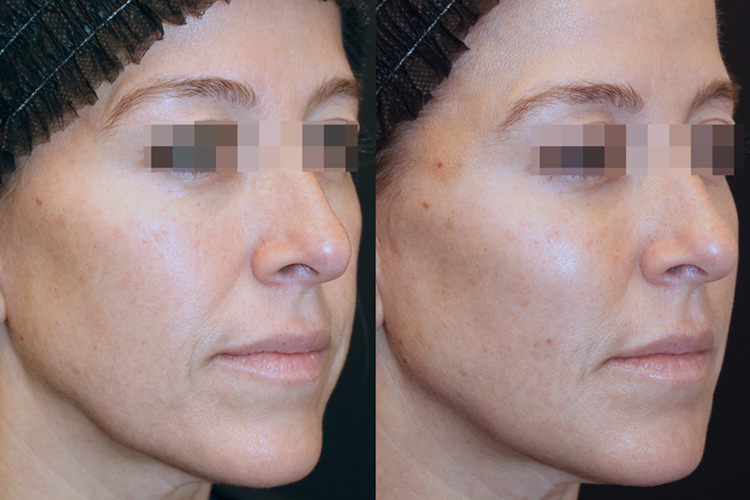 BeautiFill™ Before & After